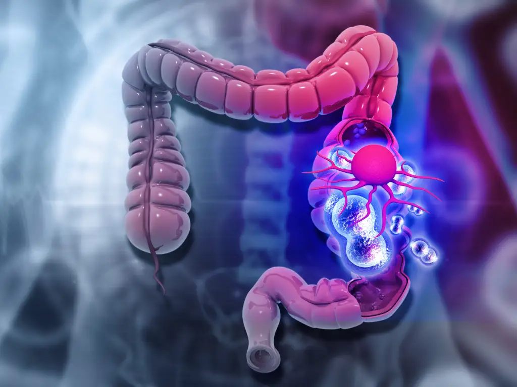 Colorectal Cancer Singapore