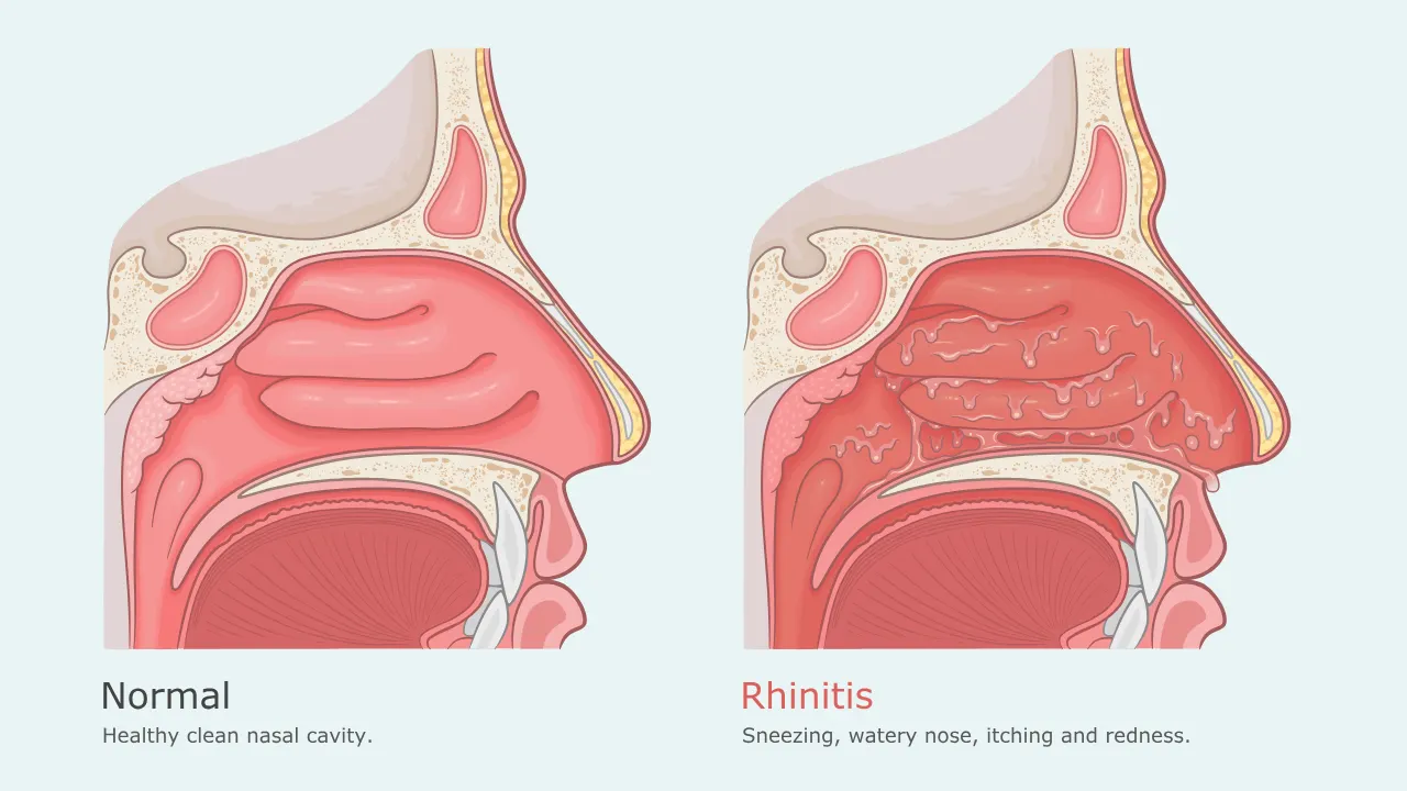 Allergic Rhinitis Singapore