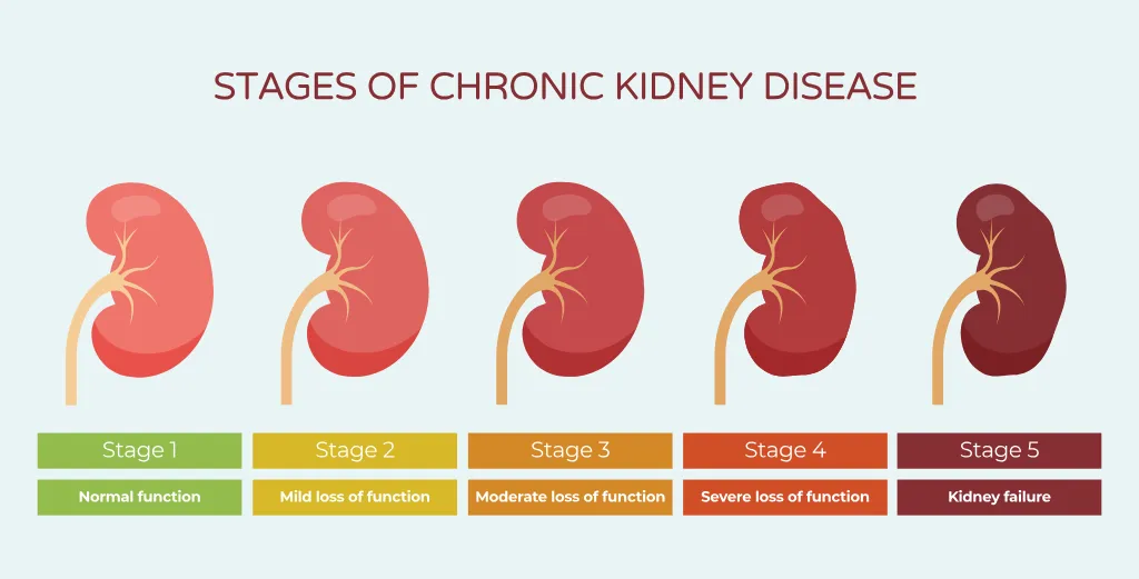 Chronic Kidney Disease Stages