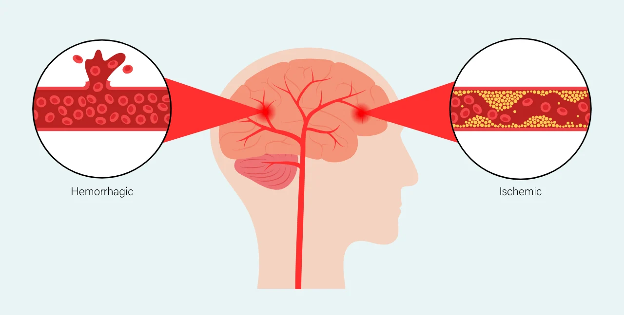 Jenis-jenis Stroke