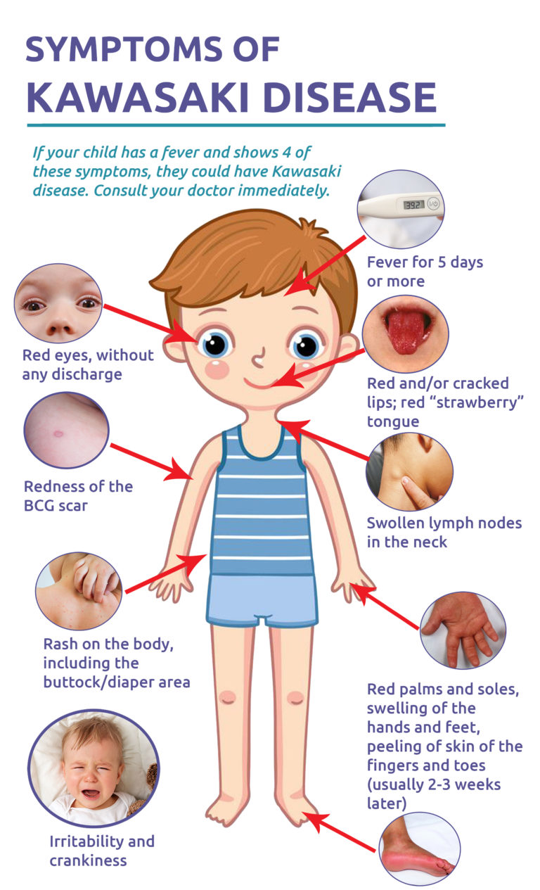 Kawasaki Disease System Disorder Template