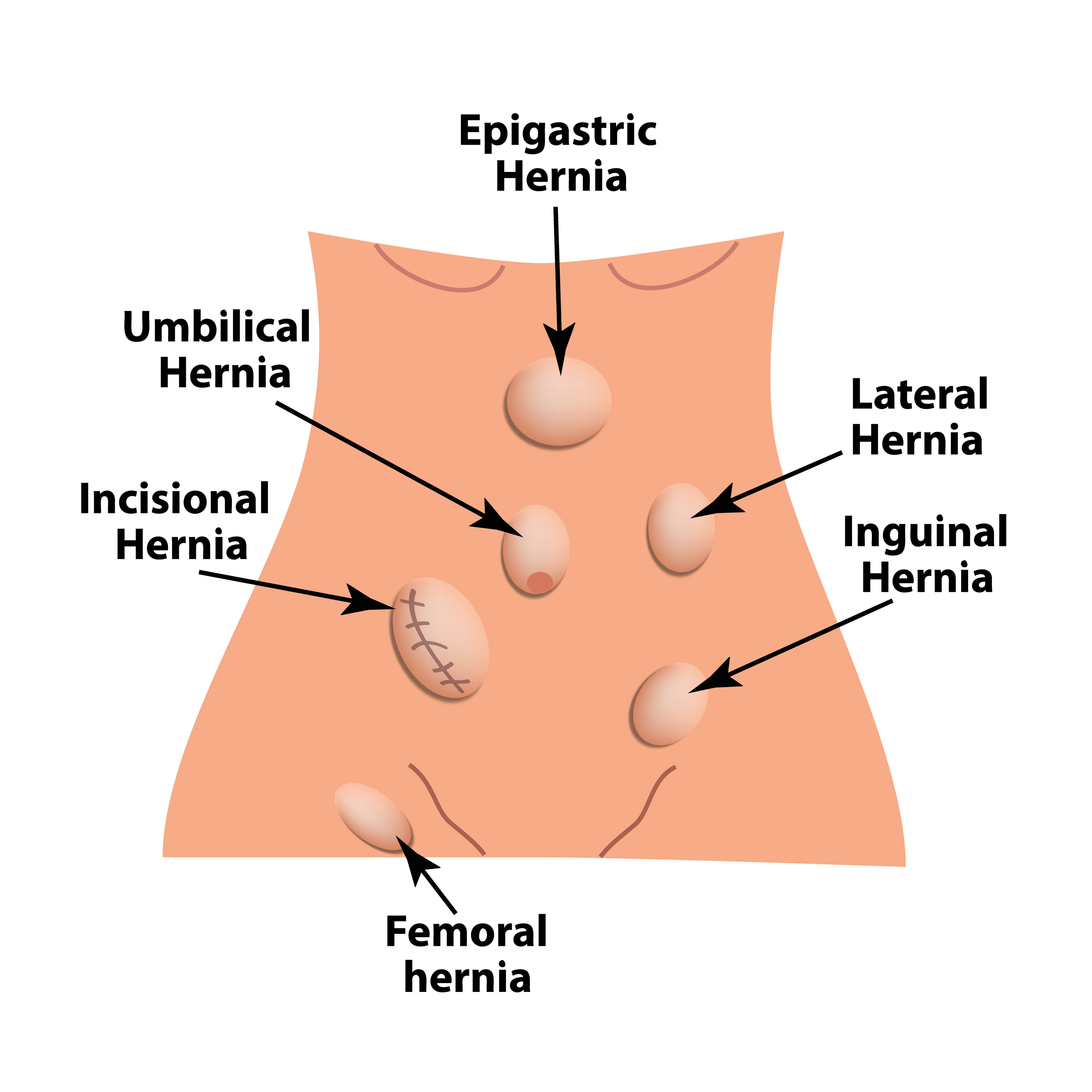 an illustration image of different types of hernia on the body for what happens when you have hernia page